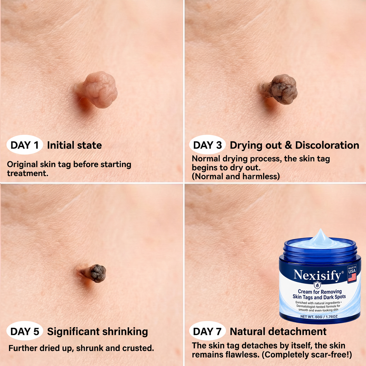 Advanced Correcting Cream for Skin Tags, Moles & Spots – 7‑Day Painless & Scar‑Free – Advanced Care for Skin Imperfections