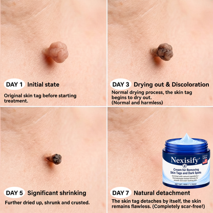 Advanced Correcting Cream for Skin Tags, Moles & Spots – 7‑Day Painless & Scar‑Free – Advanced Care for Skin Imperfections